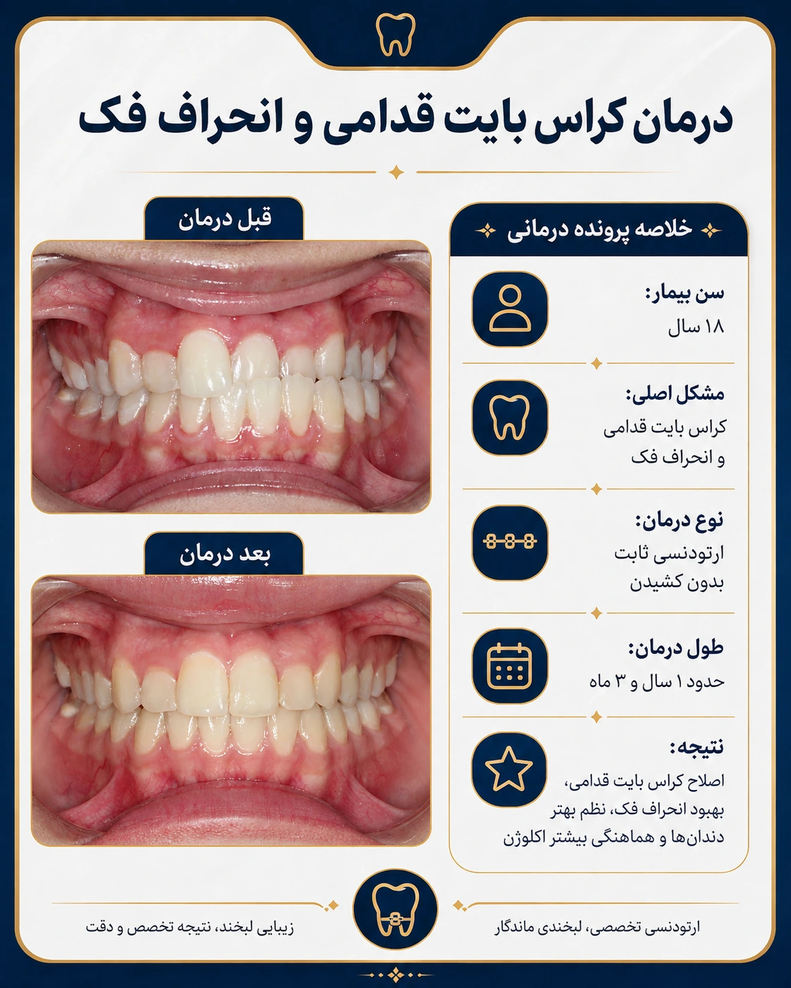درمان کراس‌بایت قدامی و انحراف فک