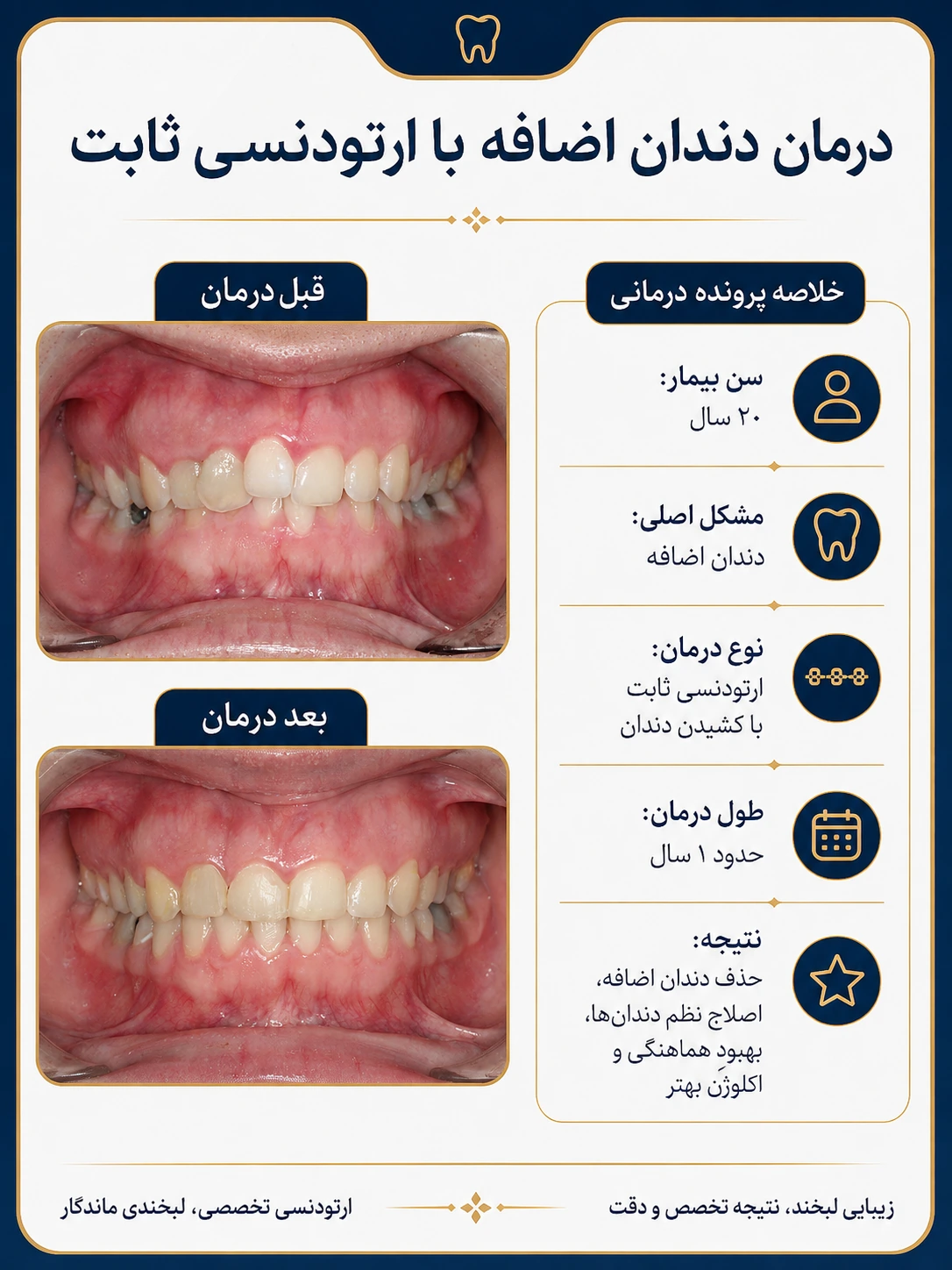 درمان دندان اضافه با ارتودنسی ثابت