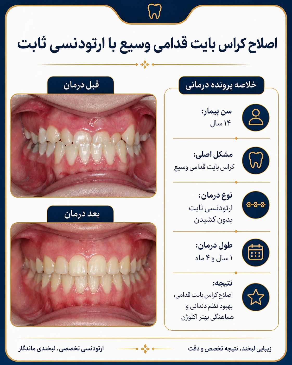 اصلاح کراسبایت قدامی وسیع با ارتودنسی ثابت؛ تصویر قبل و بعد درمان